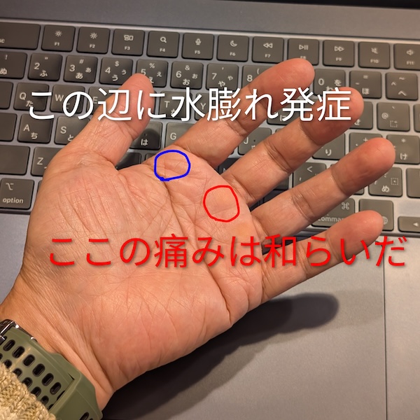 足裏に痛みが発生する場所を手のひらに記入